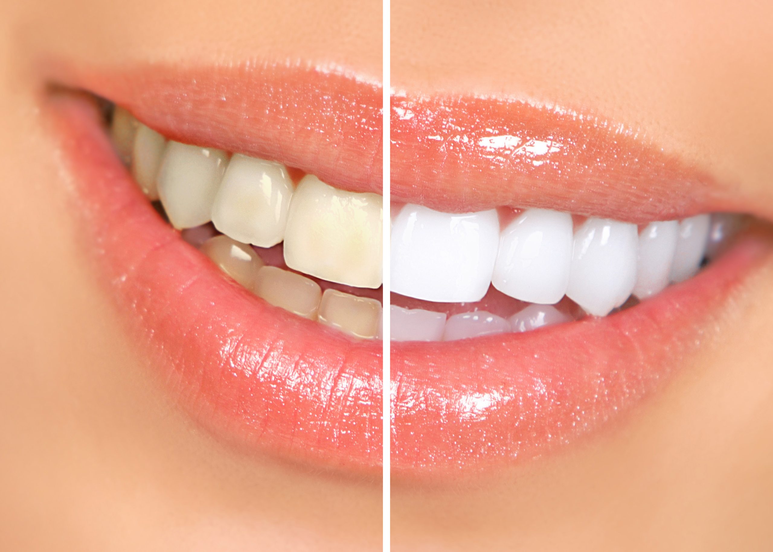 Before and after Smile Design treatment showing a natural-looking smile transformation at Greater Dental Health
